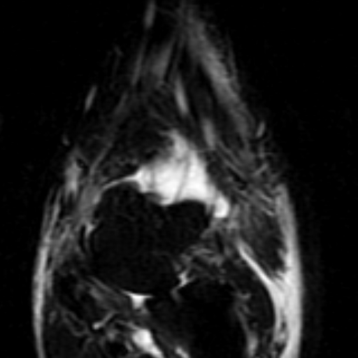 File:Anterior talofibular ligament rupture (Radiopaedia 15831-15484 Coronal STIR 5).jpg