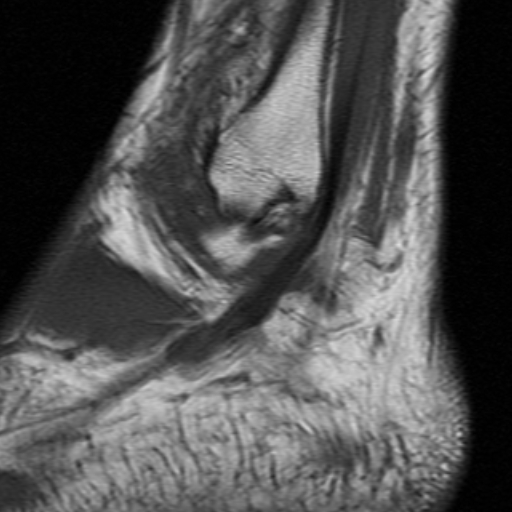 File:Anterior talofibular ligament rupture (Radiopaedia 15831-15484 Sagittal T1 4).jpg