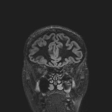 Anterior temporal encephalocele (Radiopaedia 82624-96808 Coronal FLAIR 11).jpg