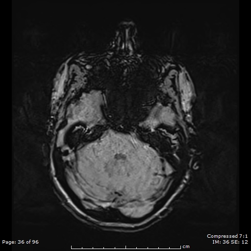 File:Anterior temporal lobe perivascular space (Radiopaedia 88283-104914 Axial SWI 5).jpg