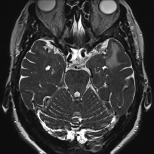 File:Anterior temporal pole cysts (Radiopaedia 46629-51102 Axial 37).png