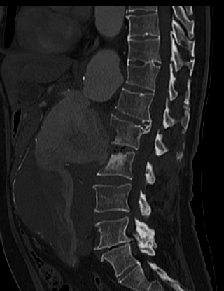 File:Anterior vertebral scalloping (abdominal aortic aneurysm) (Radiopaedia 66744-76067 Sagittal bone window 31).jpg