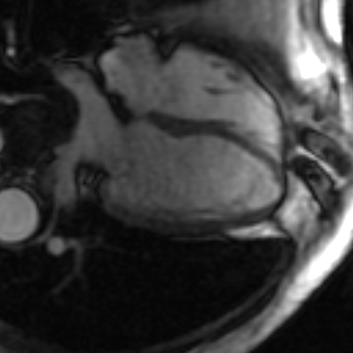 File:Anteroseptal hypokinesia after myocardial infarction (Radiopaedia 15978-15633 4 chamber view SSFE 27).jpg