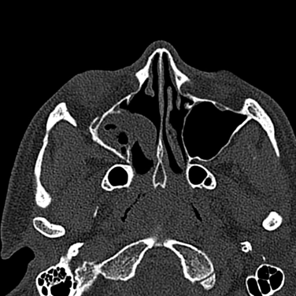 Antrochoanal polyp (Radiopaedia 30002-30554 Axial bone window 29).jpg