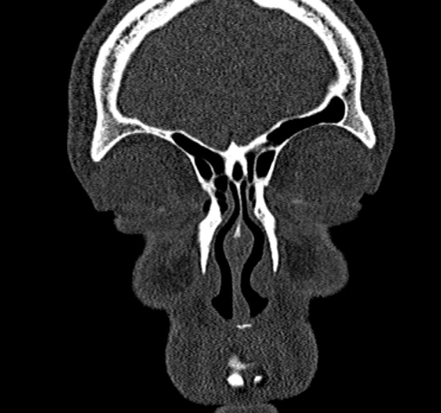 Antrochoanal polyp (Radiopaedia 30002-30554 Coronal bone window 18).jpg