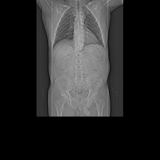 File:Aortectomy and axillary-bifemoral bypass (Radiopaedia 28303-28545 Topogram 0.6 T20f 1).jpg