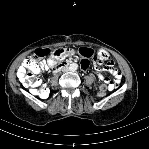 File:Aortic aneurysm and Lemmel syndrome (Radiopaedia 86499-102554 A 47).jpg