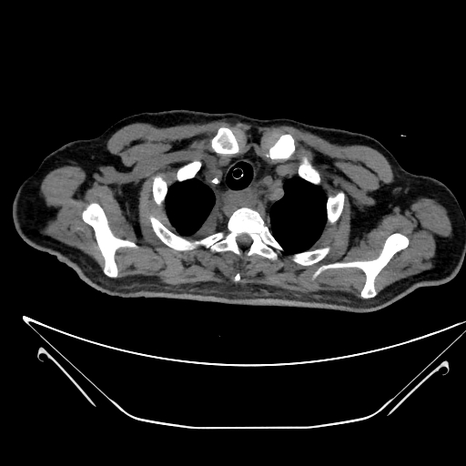 Aortic arch aneurysm (Radiopaedia 84109-99365 Axial non-contrast 42).jpg