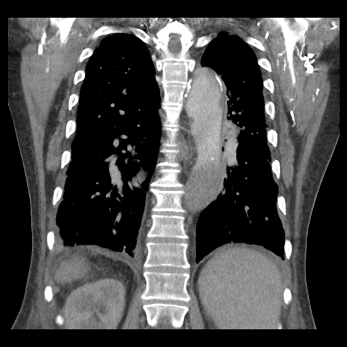 Aortic arch graft infection (FDG PET-CT) (Radiopaedia 71975-82437 Coronal 44).jpg