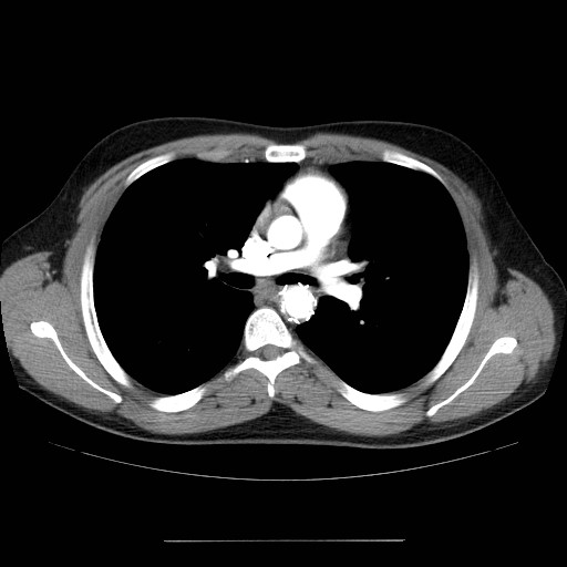 File:Aortic arch stent (Radiopaedia 30030-30595 D 16).jpg