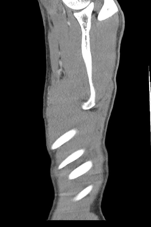 Aortic coarctation with aneurysm (Radiopaedia 74818-85828 B 151).jpg