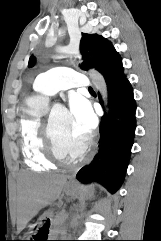 Aortic coarctation with aneurysm (Radiopaedia 74818-85828 B 97).jpg