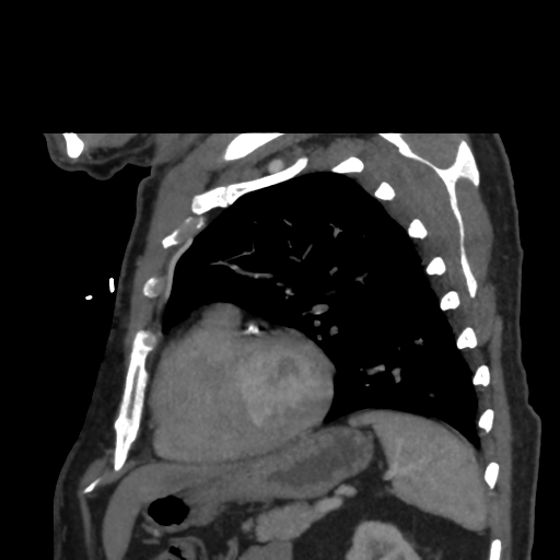 File:Aortic dissection- Stanford A (Radiopaedia 37759-39664 D 30).png