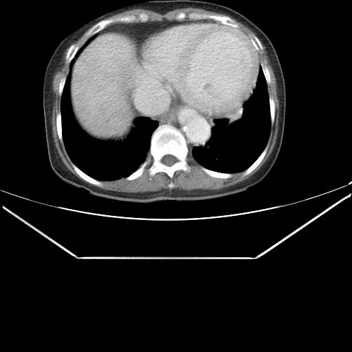 File:Aortic dissection (Radiopaedia 25350-25604 C 41).jpg
