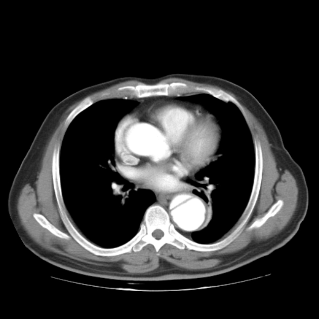 Aortic dissection (Radiopaedia 44411-48061 C 14).jpg
