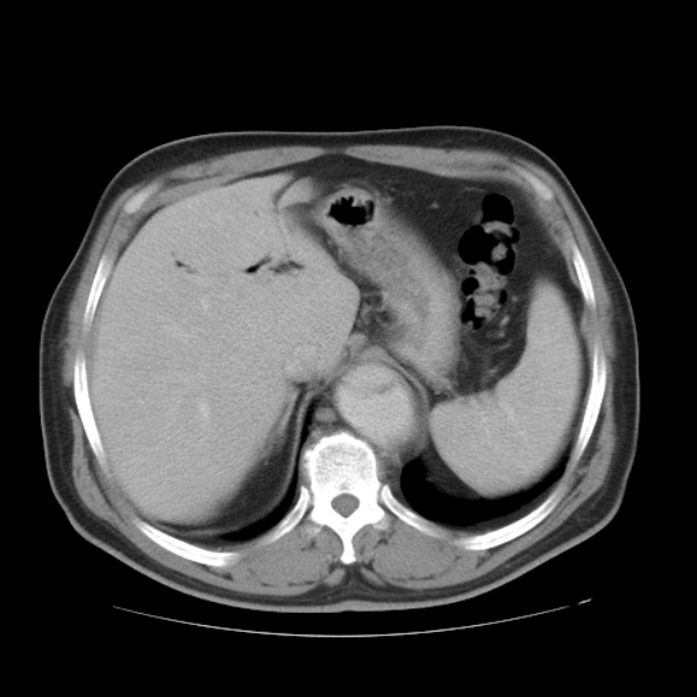 Aortic dissection (Radiopaedia 44411-48061 C 70).jpg