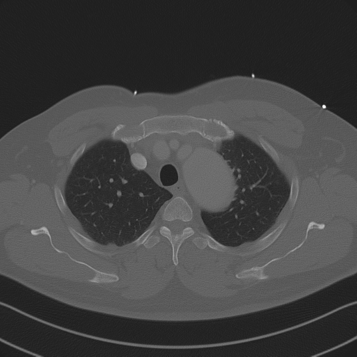 File:Aortic dissection (Radiopaedia 50763-56234 Axial bone window 29).png