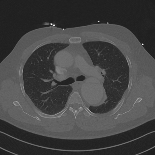Aortic dissection (Radiopaedia 50763-56234 Axial bone window 45).png