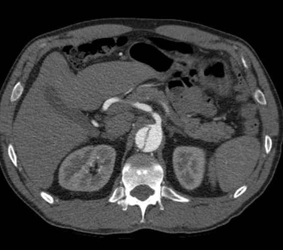 Aortic dissection - Stanford type B (Radiopaedia 73648-84437 A 128).jpg