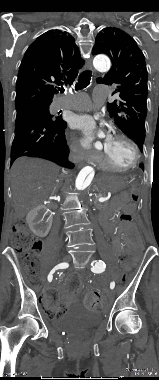 Aortic dissection with extension into aortic arch branches (Radiopaedia 64402-73204 A 40).jpg