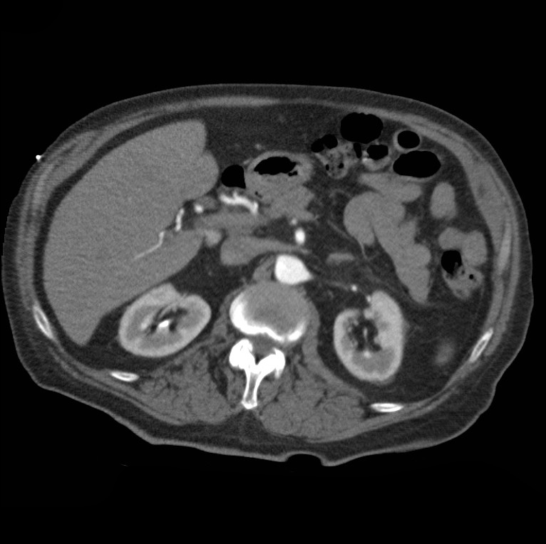 Aortic dissection with rupture into pericardium (Radiopaedia 12384-12647 A 59).jpg