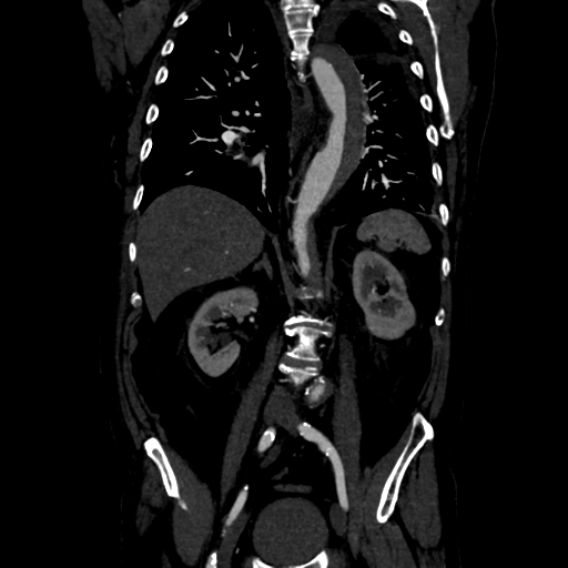 Aortic intramural hematoma (Radiopaedia 34260-35540 C 56).png