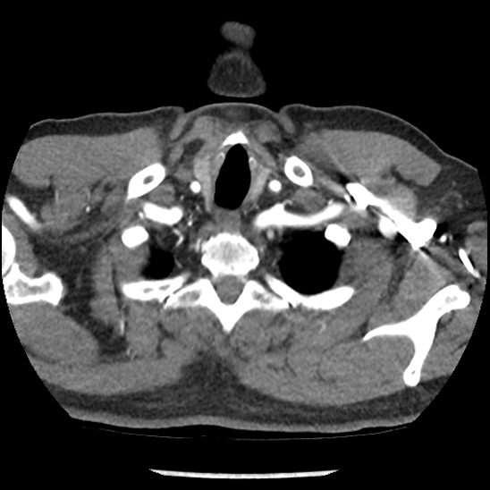 Aortic intramural hematoma (type B) (Radiopaedia 79323-92387 B 1).jpg