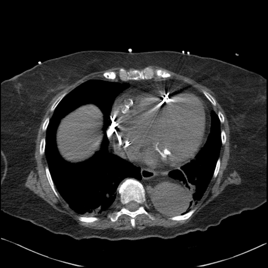 Aortic intramural hematoma with dissection and intramural blood pool (Radiopaedia 77373-89491 Axial non-contrast 67).jpg