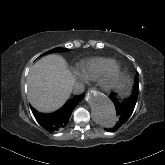 Aortic intramural hematoma with dissection and intramural blood pool (Radiopaedia 77373-89491 Axial non-contrast 76).jpg