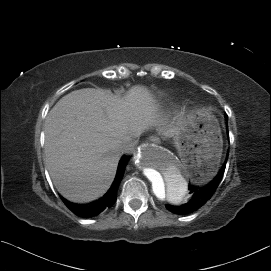 Aortic intramural hematoma with dissection and intramural blood pool (Radiopaedia 77373-89491 B 91).jpg
