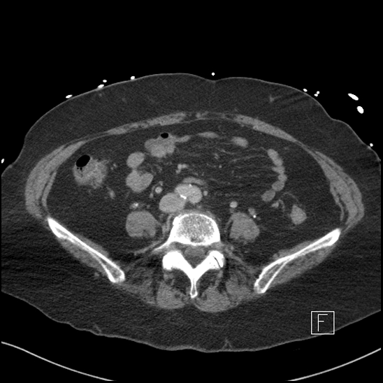 File:Aortic intramural hematoma with dissection and intramural blood pool (Radiopaedia 77373-89491 E 59).jpg