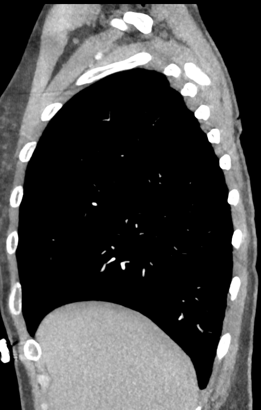 Aortic valve non-coronary cusp thrombus (Radiopaedia 55661-62189 C+ arterial phase 60).png