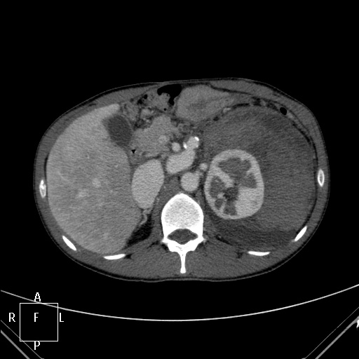 File:Aorto-left renal vein fistula (Radiopaedia 45534-49628 A 13).jpg