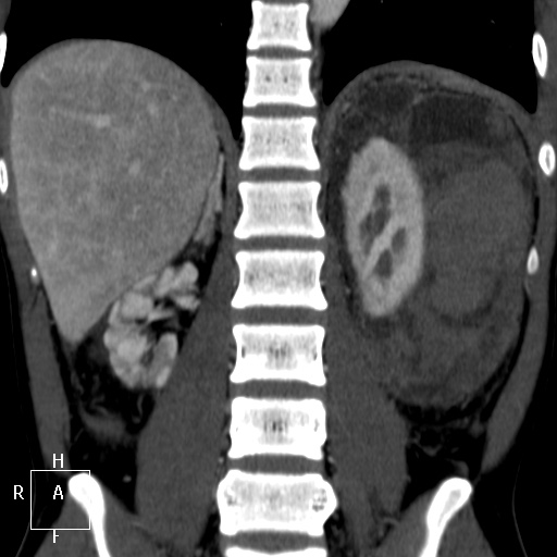 Aorto-left renal vein fistula (Radiopaedia 45534-49628 B 49).jpg