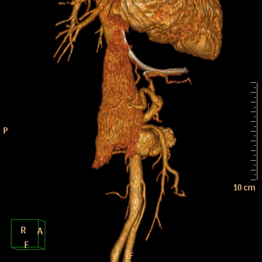 File:Aorto-left renal vein fistula (Radiopaedia 45534-49628 D 14).jpg