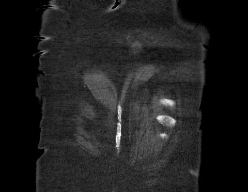 Aortoesophageal fistula with endovascular repair (Radiopaedia 73781-84592 Coronal C+ CTPA 137).jpg