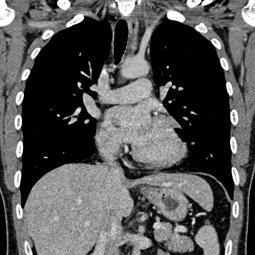 Apical lung mass mimic - neurogenic tumor (Radiopaedia 59918-67521 B 61).jpg