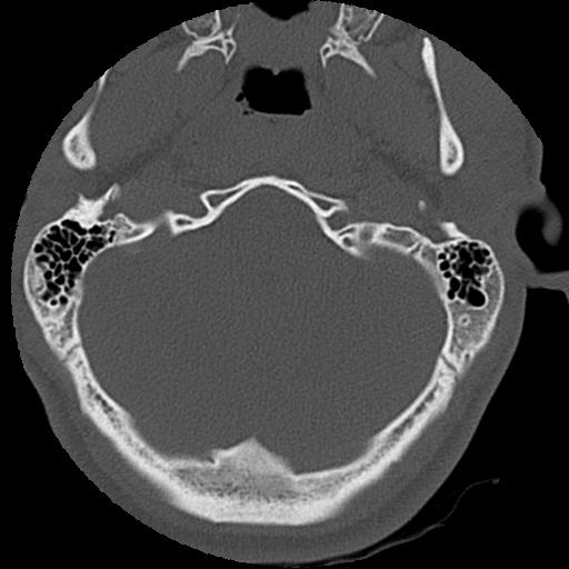 File:Apical pneumothorax on cervical spine CT (Radiopaedia 45343-49368 Axial bone window 2).jpg