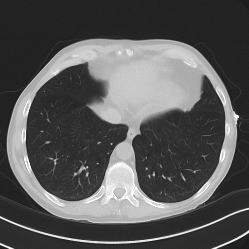 File:Apical pulmonary metastasis (Radiopaedia 46338-50754 Axial non-contrast 50).png