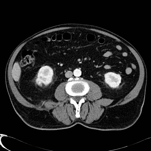 File:Appendiceal adenocarcinoma complicated by retroperitoneal abscess (Radiopaedia 58007-65039 B 73).jpg