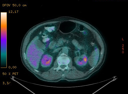 Appendiceal adenocarcinoma complicated by retroperitoneal abscess (Radiopaedia 58007-65041 Axial PET-CT 116).jpg