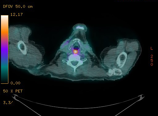 Appendiceal adenocarcinoma complicated by retroperitoneal abscess (Radiopaedia 58007-65041 Axial PET-CT 21).jpg