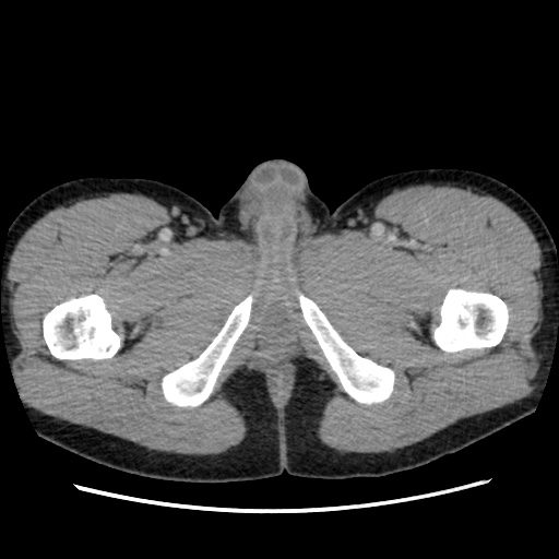 File:Appendicitis complicated by post-operative collection (Radiopaedia 35595-37114 A 95).jpg