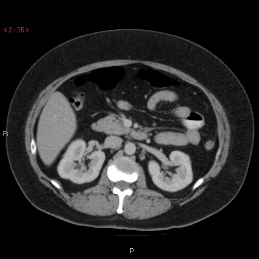 File:Appendicitis with microperforation- promontoric type (Radiopaedia 27268-27442 C 23).jpg