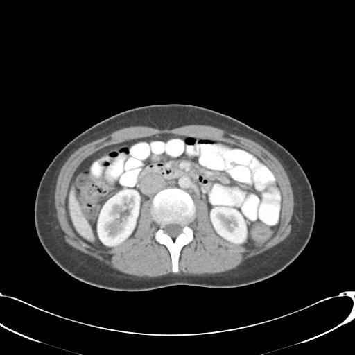 Appendicitis with minimal stranding but appendicolith (Radiopaedia 29035-29397 A 37).jpg