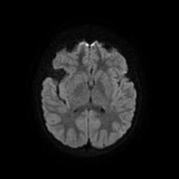 Arachnoid cyst - middle cranial fossa (Radiopaedia 67671-77088 Axial DWI 16).jpg