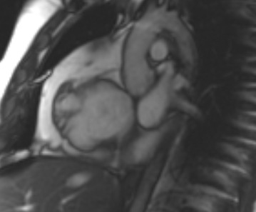 Arrhythmogenic right ventricular cardiomyopathy (Radiopaedia 69431-79307 Short axis cine 240).jpg