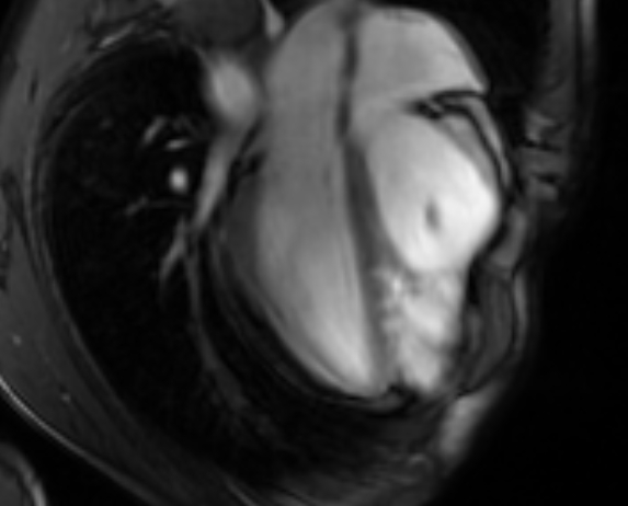Arrhythmogenic right ventricular cardiomyopathy (Radiopaedia 69564-79464 4ch cine 69).jpg