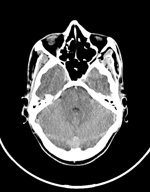 Arrow injury to the brain (Radiopaedia 72101-82607 Axial non-contrast 60).jpg