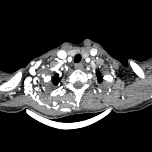 Arteriovenous malformation of the neck (Radiopaedia 53935-60062 A 5).jpg